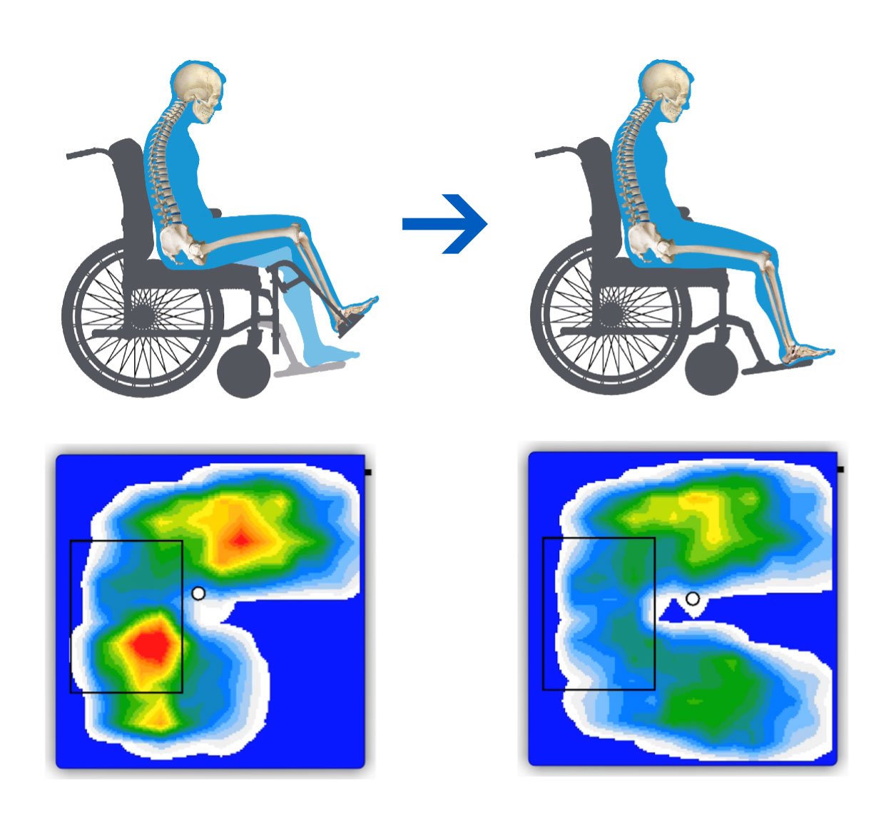 Pressure mapping a method to investigate persistent pressure injuries